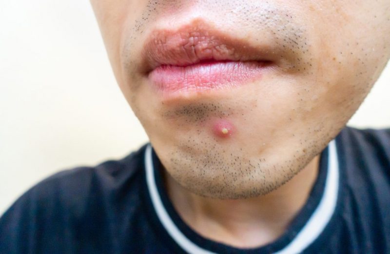 ニキビの部位別治療を行う東京のしらゆり皮膚科