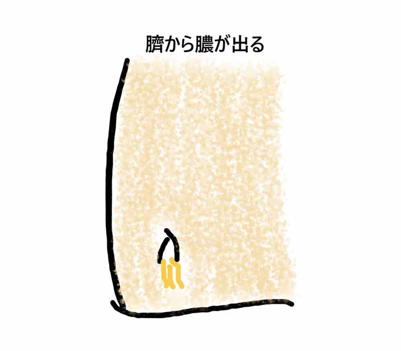 おへその炎症を繰り返しています。 尿膜管遺残 -大和クリニック-木更津市の泌尿器科