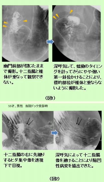 胃透視検査栃木県立がんセンタ