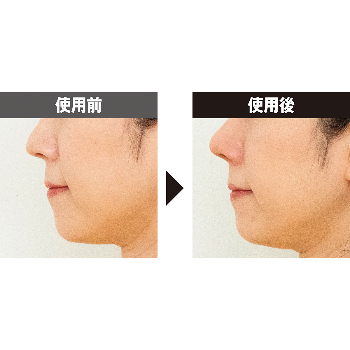 LUXCEAR公式 ノーズクリップ 鼻を高く Fornez 鼻矯正 鼻専用美顔器 鼻クリップ 鼻プチ 美鼻 ルクセア フォーネス :LUXCEAR 公式ショップ - 通販 - Yahoo!ショッピング