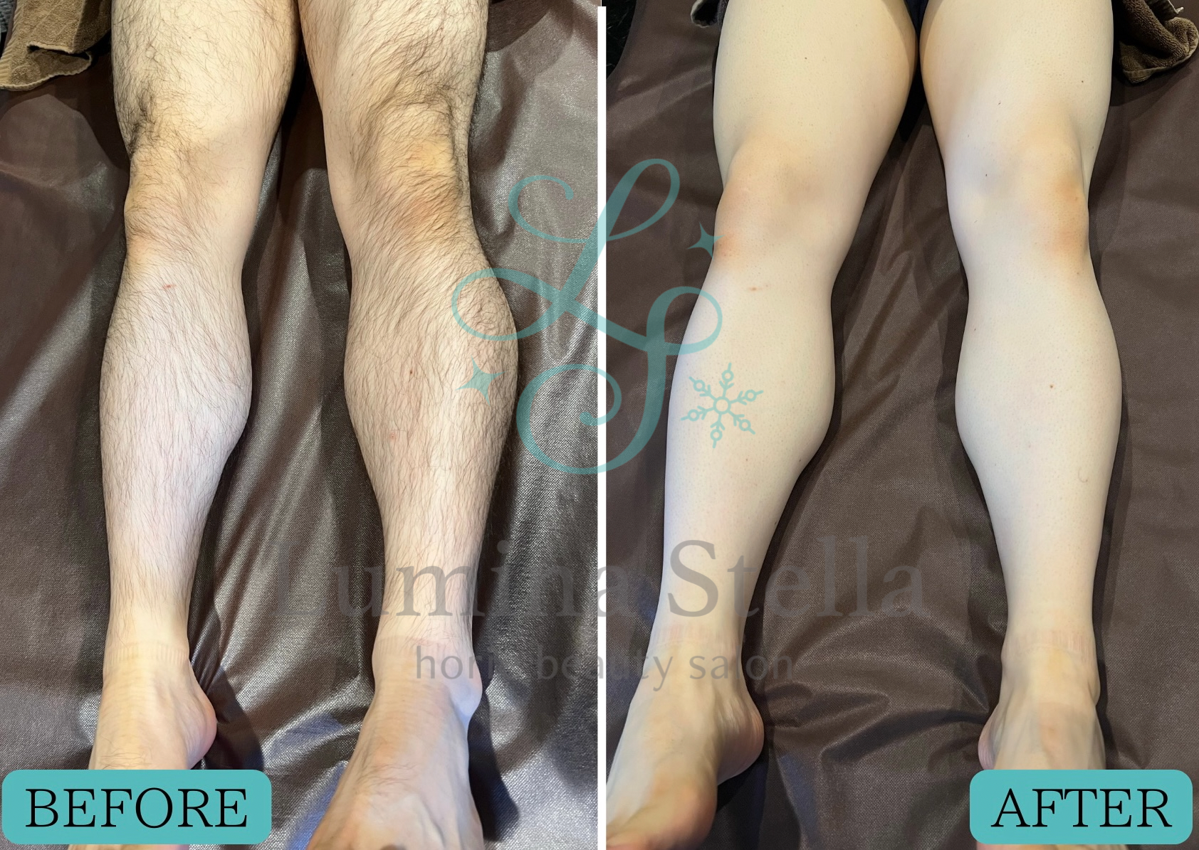 足まるごと脱毛🦵🦵 メンズの足脱毛のビフォー＆アフター 3ヶ月経過 前回脱毛からから2週間何もしない剃らない状態で来ていただいていますもうこんなに減毛してます。 足を出す夏までにはつるつるですね✨✨ メンズ両足丸ごと脱毛お試し¥6600