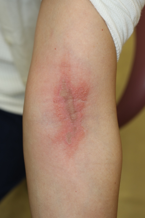 蕁麻疹 じんましん の症状と原因は？驚くほど多いその種類。 - ＜美容ソムリエ＞