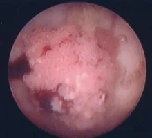 溝状舌 là gì? Cách đọc, phiên âm & nghĩa của từ 溝状舌