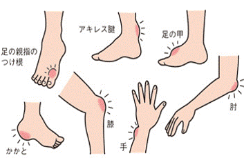 尿酸値が高いと痛風になることも激痛！痛風を予防する高尿酸血症・痛風患者さま・一般の皆さま三和化学研究所 SKK