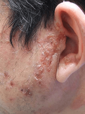 マラセチアとは？身近な「カビ」であるマラセチア菌について解説肌トラブルとスキンケア持田ヘルスケア株式会社