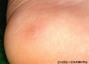 ウイルス性イボの治療なら名古屋市南区のうらた皮膚科へ皮膚科専門医による診察