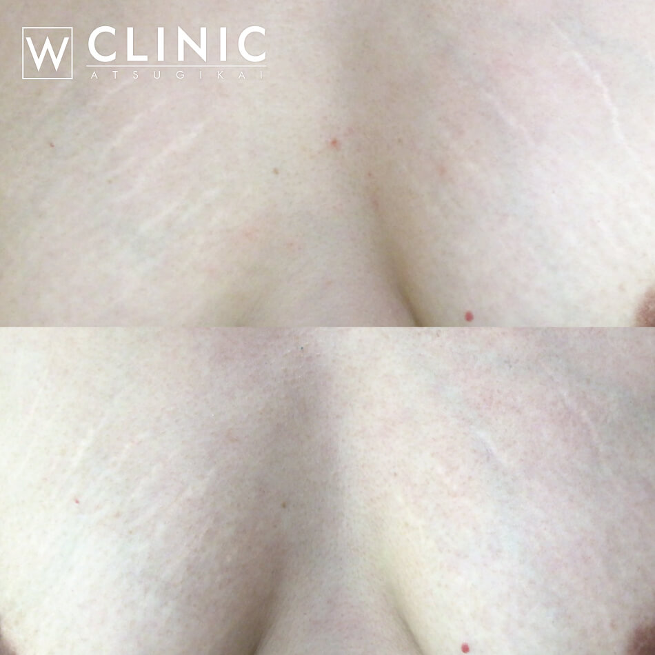 傷跡・妊娠線・肉割れアートメイク札幌ル・トロワ ビューティクリニックVogue美容外科・形成外科・皮膚科