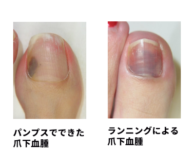 サッカーこの爪の変色を見たらどうケアする？触る？爪の見立てFile.09tsumeplus