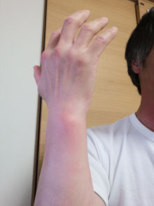 TFCC損傷の原因となる尺骨突き上げ症候群とは