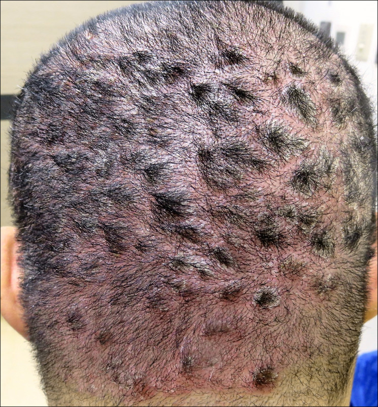 乾癬表現很多樣，正確診斷很重要 照護線上-深受信賴的醫療媒體