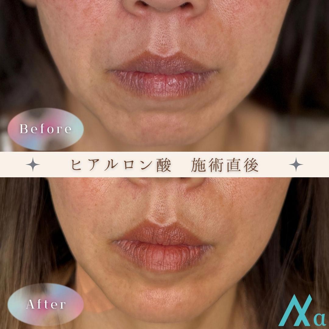 今回もやってくれましたが、どうやったら針を２回刺すだけで私の腕がこんな事になるんですかね🤔 しかも採血の方が酷いとか💉 笑点滴はまる2日付けていたので多少はわかりますが、採血したの若い子やったからなぁ😓なかなか上手い人には巡り会えませんね😅💉注射