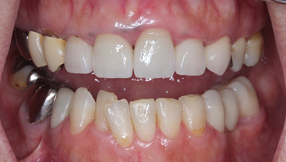 40代からの大人のための歯列矯正