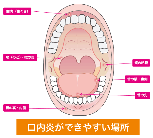 口内炎よく見られる大人の病気 - みやけ内科・循環器科 家庭の医学