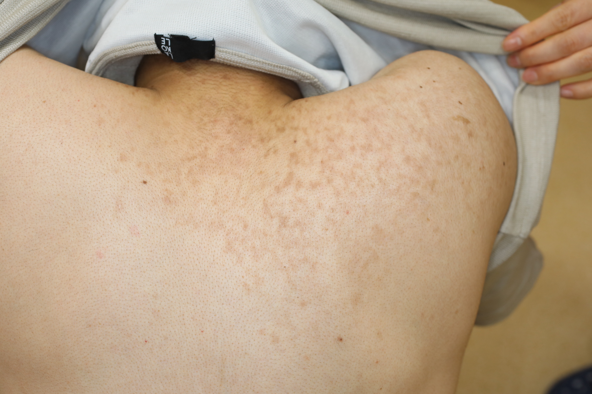 内臓からくる、かゆい湿疹とは？肝臓病や腎臓病と皮膚症状の関係を画像で解説- ヨクミテ医師監修の医療メディア