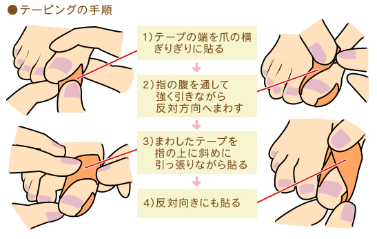 巻き爪で自分では切りにくい、病院で対応してくれなかった、そんな時は爪ケア専門店へご相談ください！サロン運営への思いやネイルのお手入れについて綴るブログ宜野湾市の爪ケアなら信頼と実績のティンカーベル