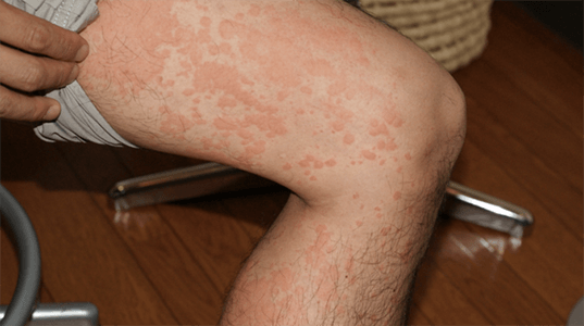 蕁麻疹が突然出る原因とは？ストレスも関係する？新宿クリニック