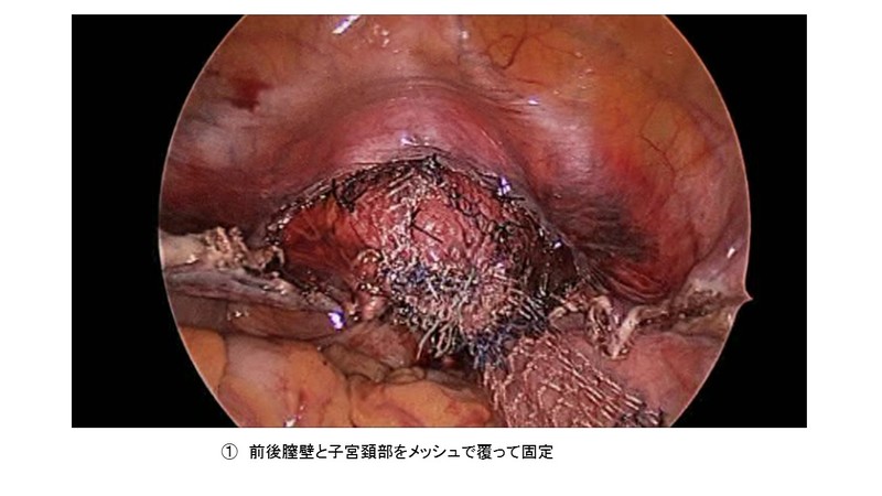 骨盤臓器脱手術のトラブル合併症、まとめてみた脱クリニック 骨盤臓器脱