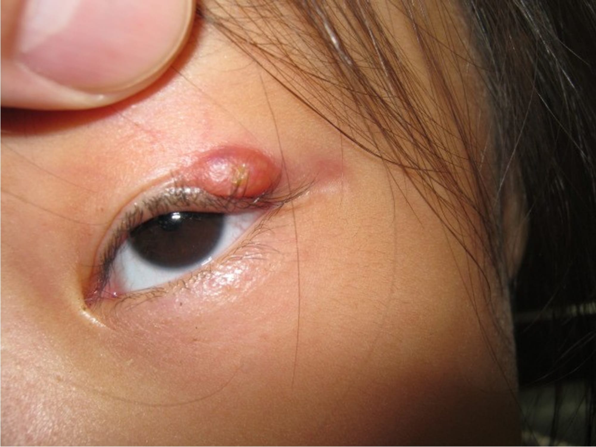 霰粒腫 麦粒腫 ものもらい めばちこ 奈良県 大和郡山市 松本眼科 治療計画