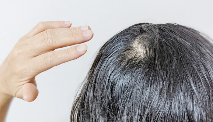 ３０代男性の薄毛 AGA 改善方法公式 Aozora スーパースカルプ旭千林店 薬を飲まない薄毛改善のパイオニア