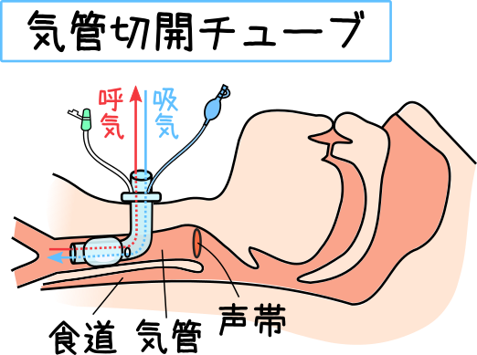 140点を超える気管切開手術のイラスト素材、ロイヤリティフリーのベクター素材グラフィックスとクリップアート - iStock