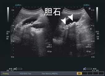 胃がん - 福岡の苦しくない内視鏡専門医療機関福岡天神内視鏡クリニック消化器福岡博多院