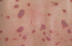 8歳女児。左頸部と左鎖骨部の紅斑、痂皮、掻痒：Cadetto.jp