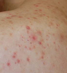 クリニックブログ岡山市南区の皮膚科うちだ皮膚科クリニックヘルペス・とびひ・乾癬・アトピー性皮膚炎など