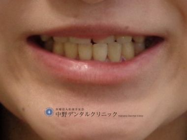 笑った時の口の形を変えたい！自宅でできるトレーニング3選をご紹介！ホワイトニングカフェで白い歯に 公式 セルフホワイトニングサロン