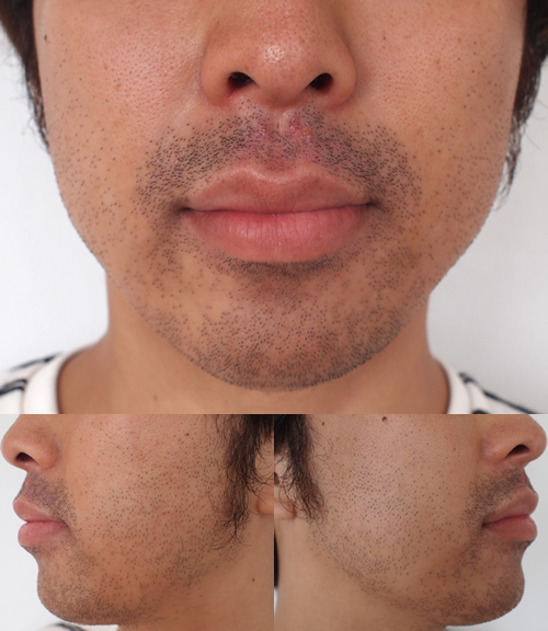 ヒゲ脱毛の効果はいつ出る？ヒゲの減り方＆仕上がりイメージを徹底解説The Style Dictionary