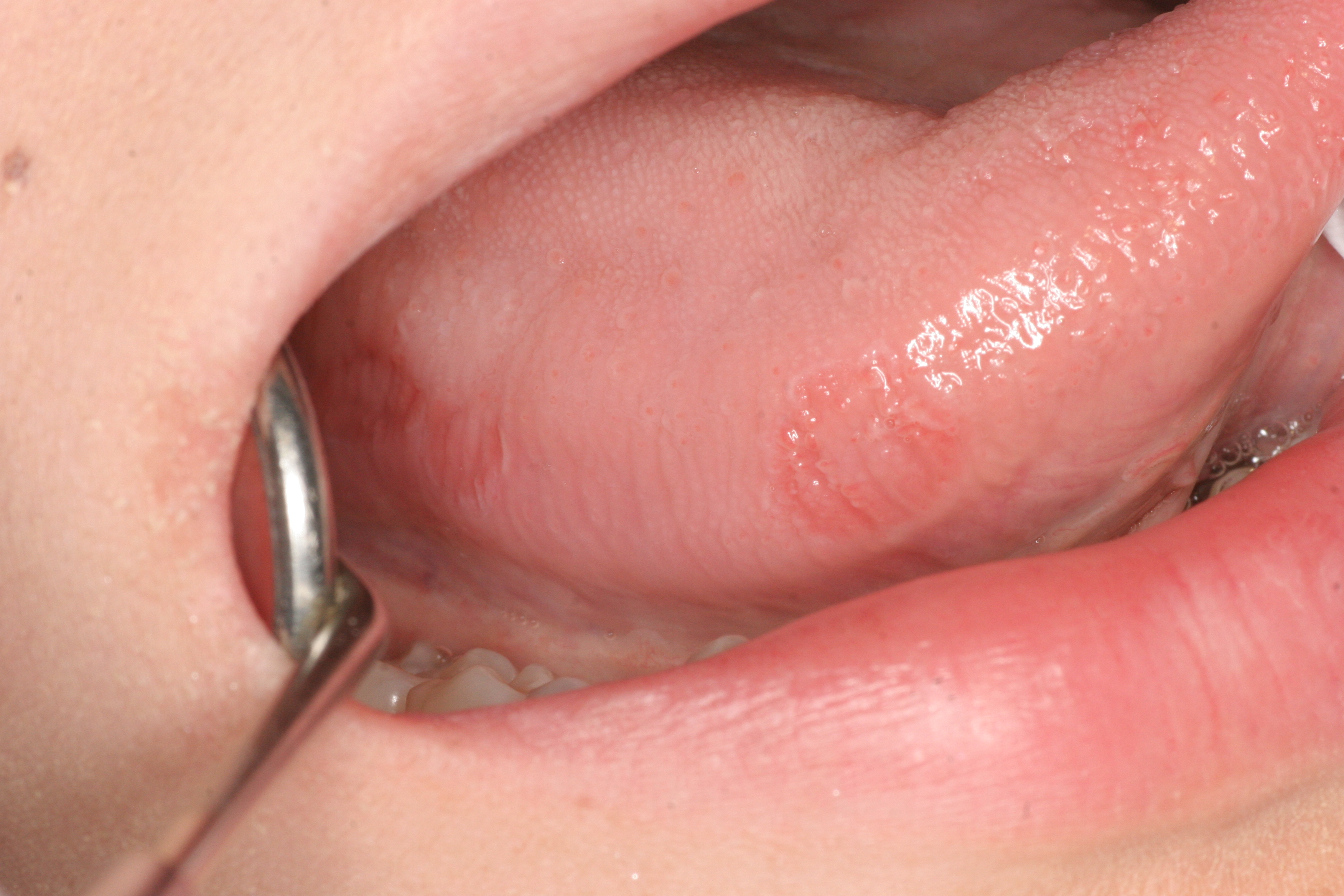 豊中市で線状苔癬を治療するなら千里中央花ふさ皮ふ科 皮膚科・アレルギー科・美容皮膚科・形成外科