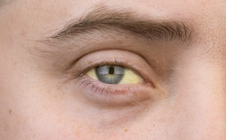 皮膚變黃不一定就是肝有問題！ 但眼睛變黃就要快就醫