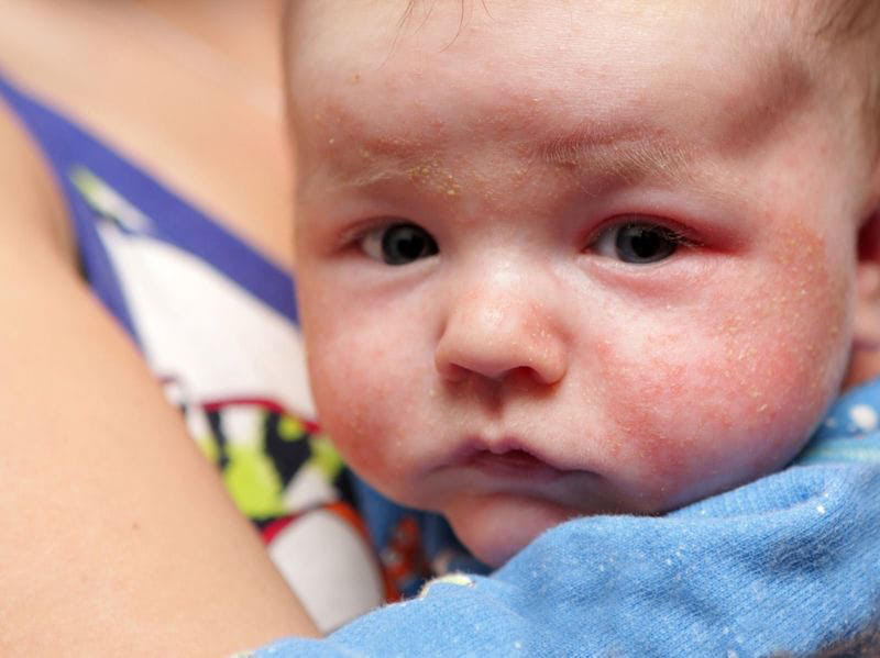 新生児落屑真っ最中👶「しんせいじらくせつ」とは 生後１〜２週間の間に、 赤ちゃんの皮膚がポロポロと剥がれる 生理現象のこと。ママのお腹の中にいるときは、 羊水や胎脂に覆われていたお肌が、 出産と同時に外気に触れて、 急激に乾燥することで起こる 自然な現象