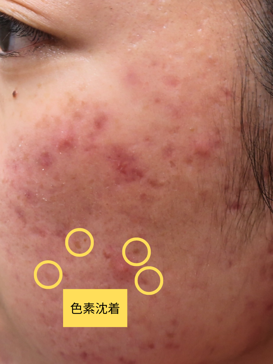 色素沈着の原因と対策。いつまでも白く美しい肌を維持する方法美容皮膚科タカミクリニック 東京 表参道