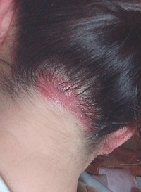 症例写真医療脱毛うなじ脱毛のメリット肌と歯のクリニック 東京ベイ幕張千葉 美容皮膚科