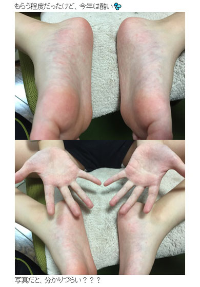 汗疱はストレスが関係する？中野の皮膚科ポラリスクリニック