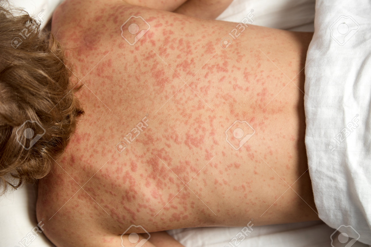 乳児に起こりやすいアトピー性皮膚炎ってなに？アトピー性皮膚炎の原因と対策について解説！ – ユーグレナ ヘルスケア・ラボ