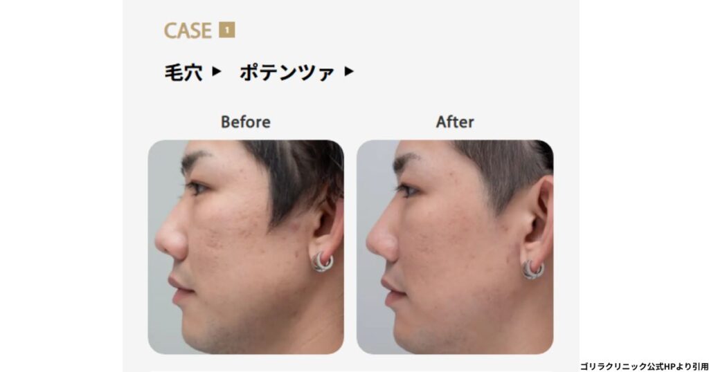 ゴリラ洗顔体験レポートハイドラフェイシャルの気になる効果と施術を公開！ - カスタムライフmedical