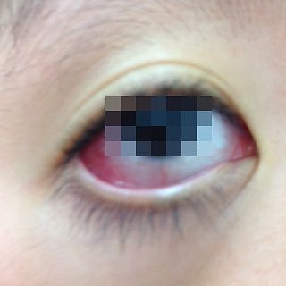 子供の結膜炎は感染症ウイルスと赤目 - 充血した目のストックフォトや画像を多数ご用意 - 充血した目, 子供, 眼 - iStock