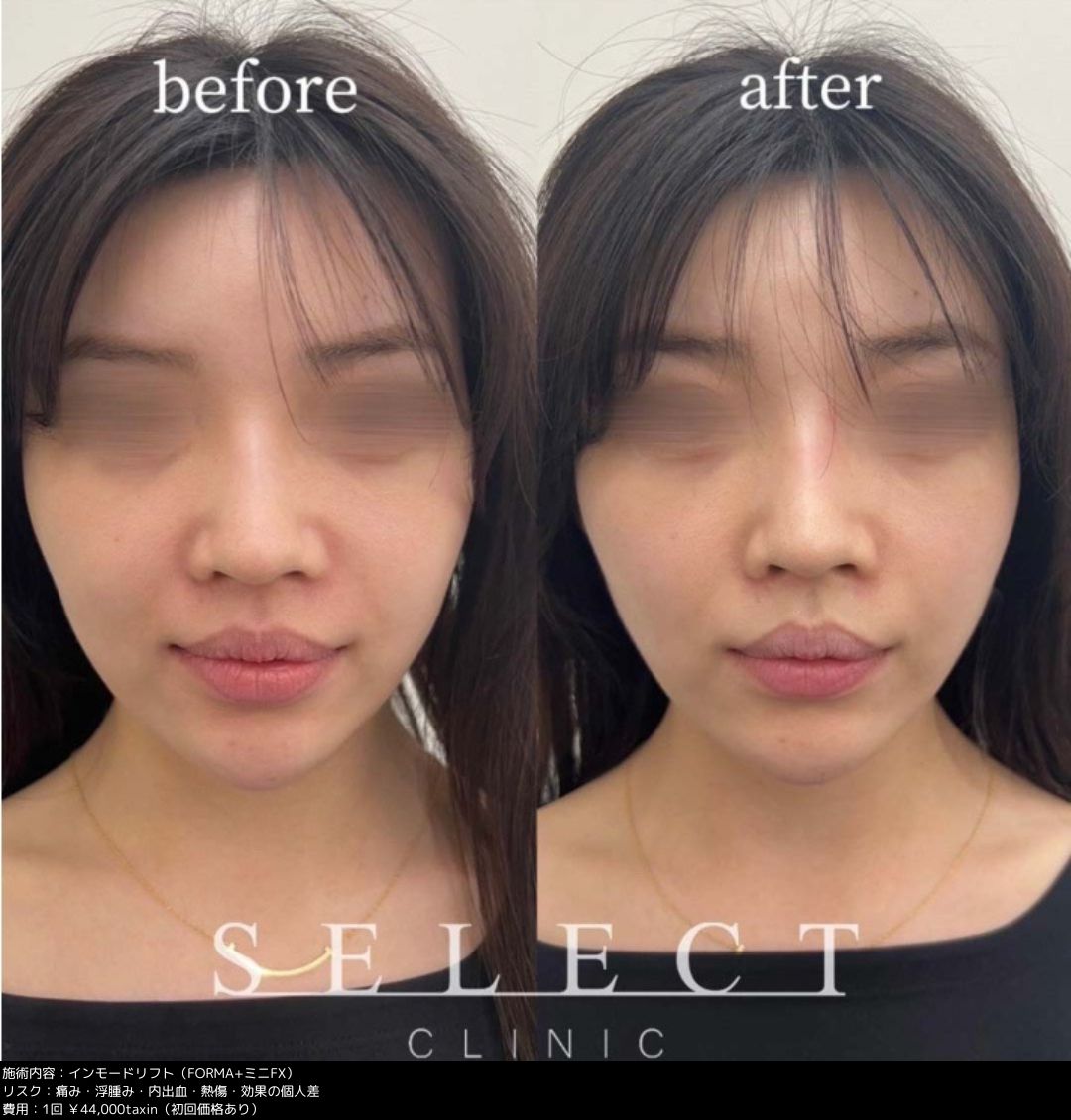 Kayos_fitness - ファスティング3日間体験 体重64.4Kg→60,4kg 体脂肪率 20,4%→15.7% たった３日間でこんなにも変わりました。 コンテストまで後3週間弱ですが、これを活かして頑張って欲しい ファスティングはホント素晴らしい❤️ファスティング 酵素ドリンク