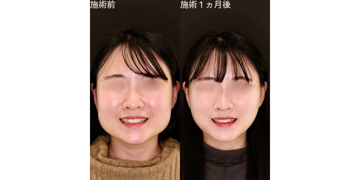小顔整形 下膨れ顔を整形やプチ整形で治す全ての方法を徹底解説