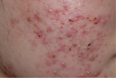 男性のニキビ・ニキビ痕治療徳島の美容クリニック 赤池クリニック