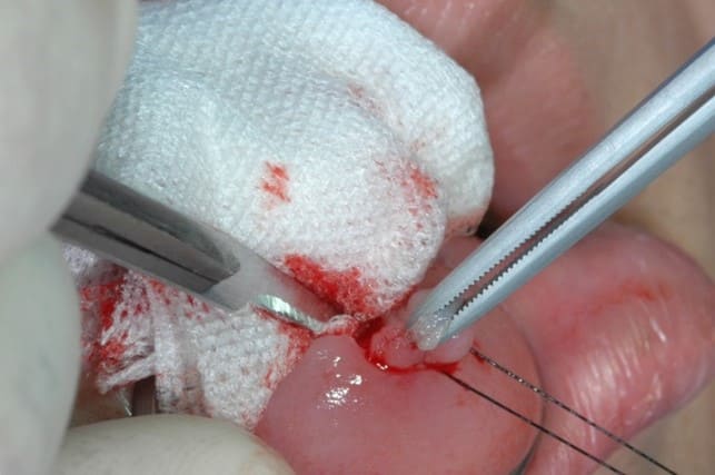 皮膚腫瘍に対する連続 分割 切除術クリニックひいらぎ皮膚科形成外科池尻大橋・渋谷・三軒茶屋