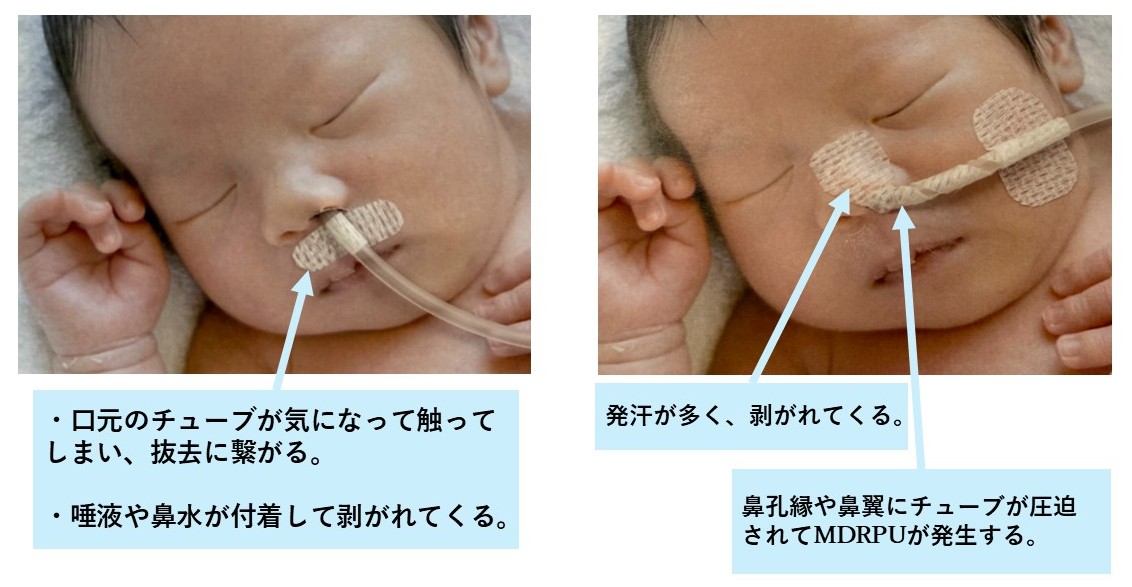 経腸栄養チューブにまつわるエトセトラ下馬栄養倶楽部