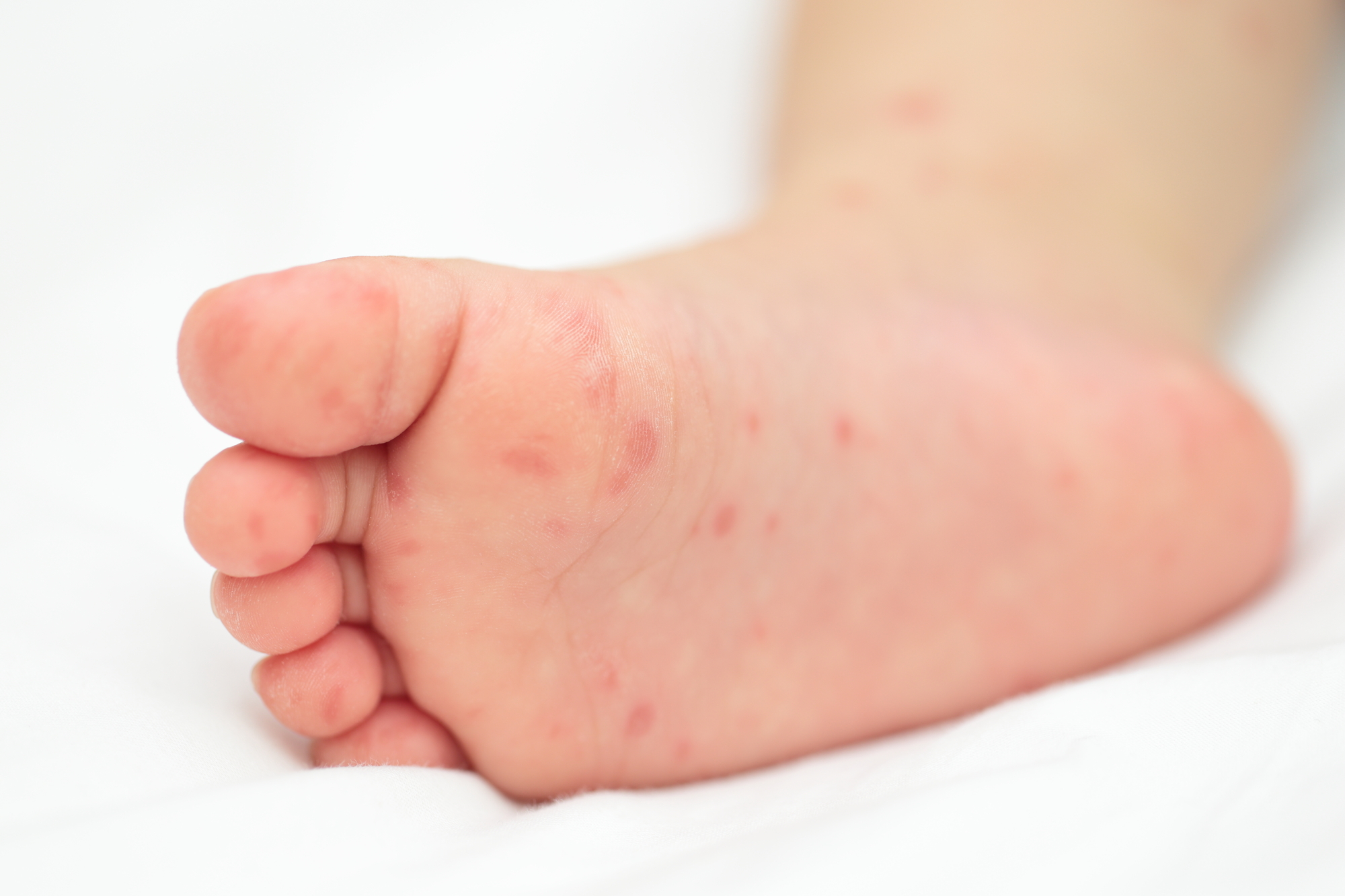 子どもがかかりやすい三大夏風邪に注意！症状と予防法を知ろうキレイキレイライオン