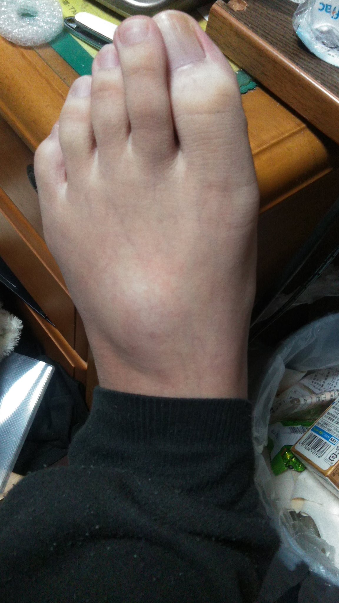 足の甲が腫れて痛む 中足骨疲労骨折- 鍼灸スポーツ整体アスイク 尼崎 塚口・武庫之荘 伊丹 美容鍼・酸素カプセル・パーソナルトレーニングダイエット