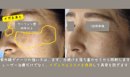 楽天市場 メガネ 跡 色素 沈着の通販