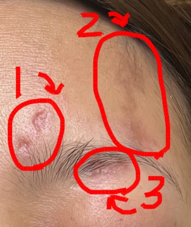 頭部の帯状疱疹で薄毛になる？症状・原因・対処法を解説CLINIC FOR