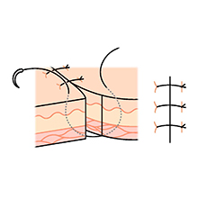図解 縫合の基本 Part3 いろいろな縫合編Antaa Slide