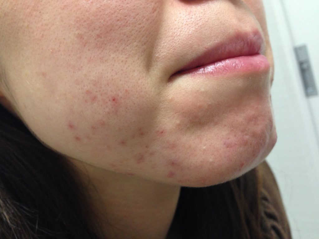 顔のブツブツニキビ・ニキビ跡の治療の治療方法・適応