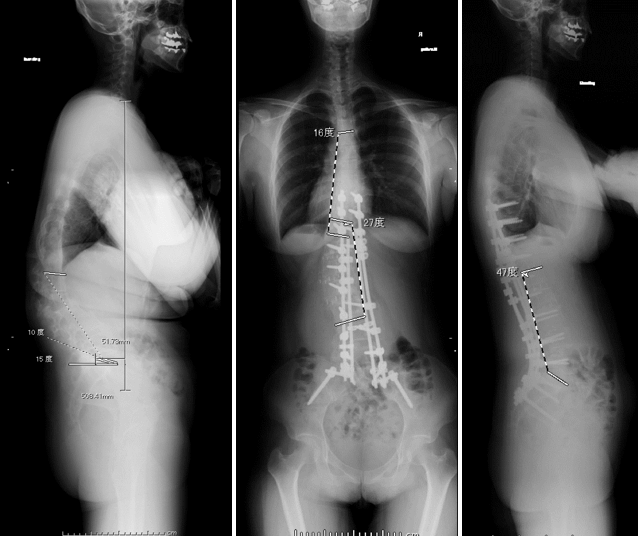 自宅で簡単にできる！脊柱側弯症のチェック方法With MagazineJA愛知厚生連
